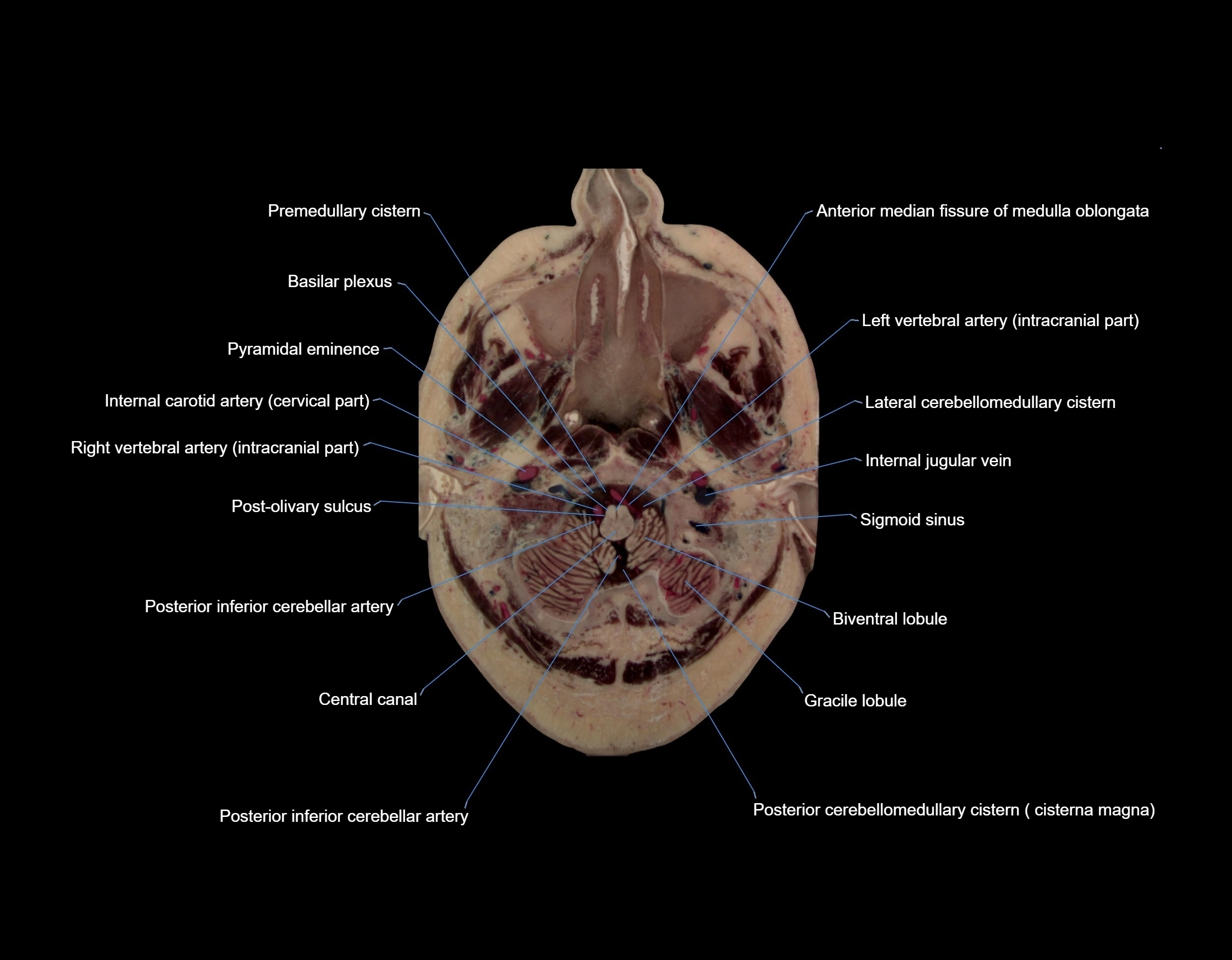 MRI Brain axial cross sectional radiology anatomy 3T image  -img-00004.webp